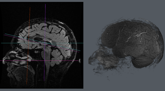 Radiologiskt högaktiv MS, Tyruko, Rituximab under lång tid och Högsignalerade förändringar